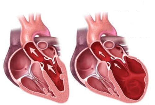 Cardiopatias